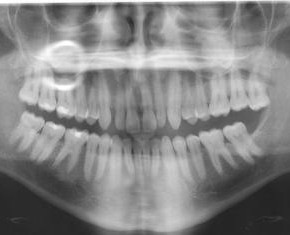 IR Furnace Dental Application